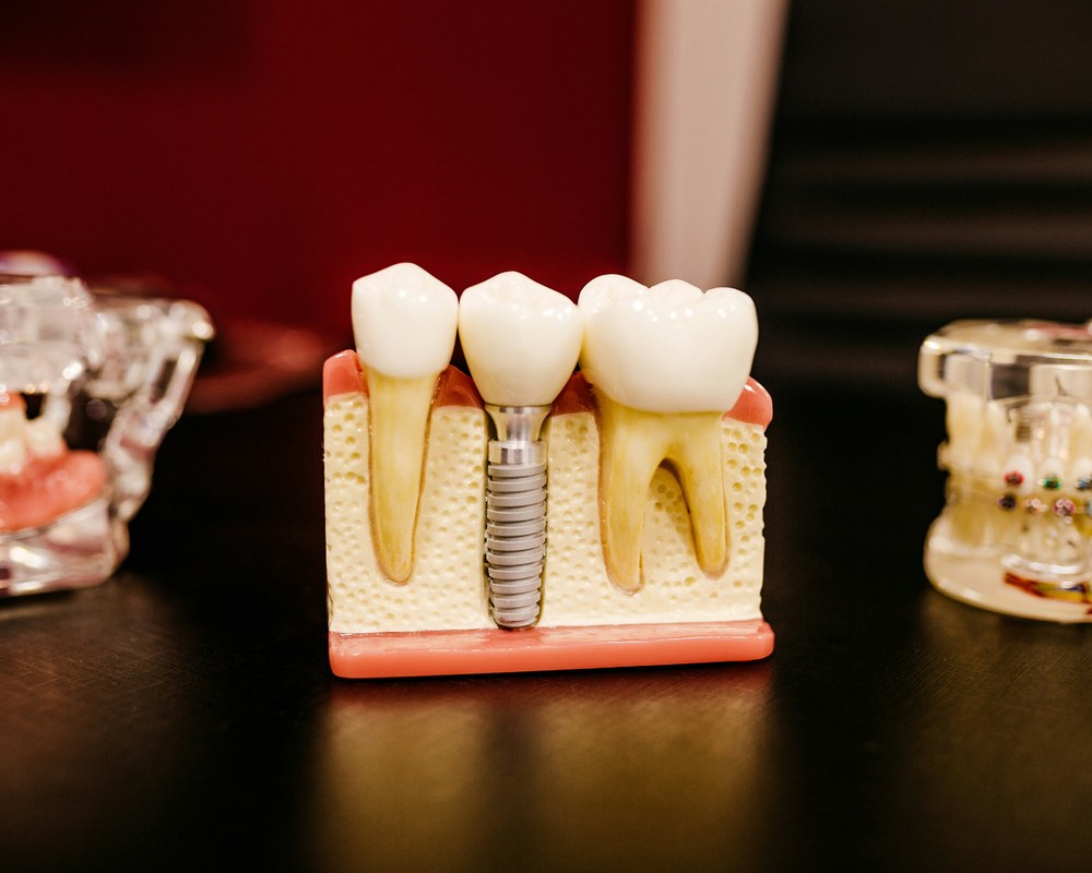Protetika — Sano Dental & Aesthetic, Kragujevac